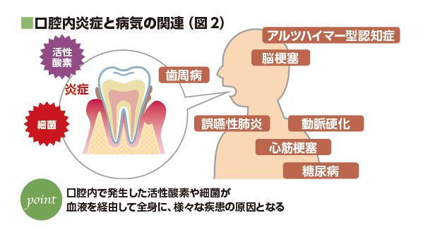口腔内炎症と病気の関連