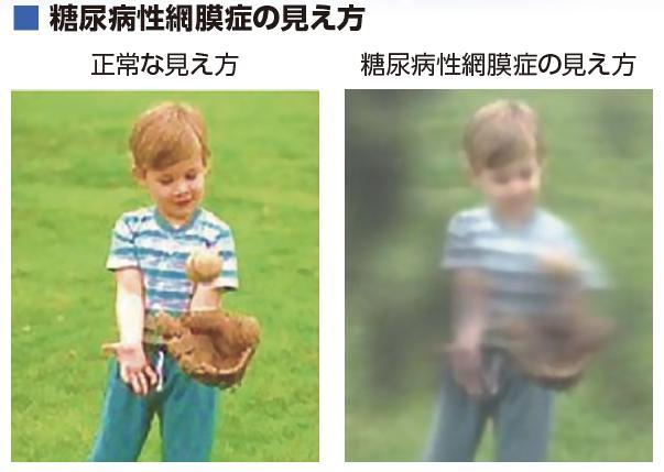 糖尿病性網膜症の見え方